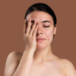 Acne: Treatment, Types, Causes, Prevention, and More