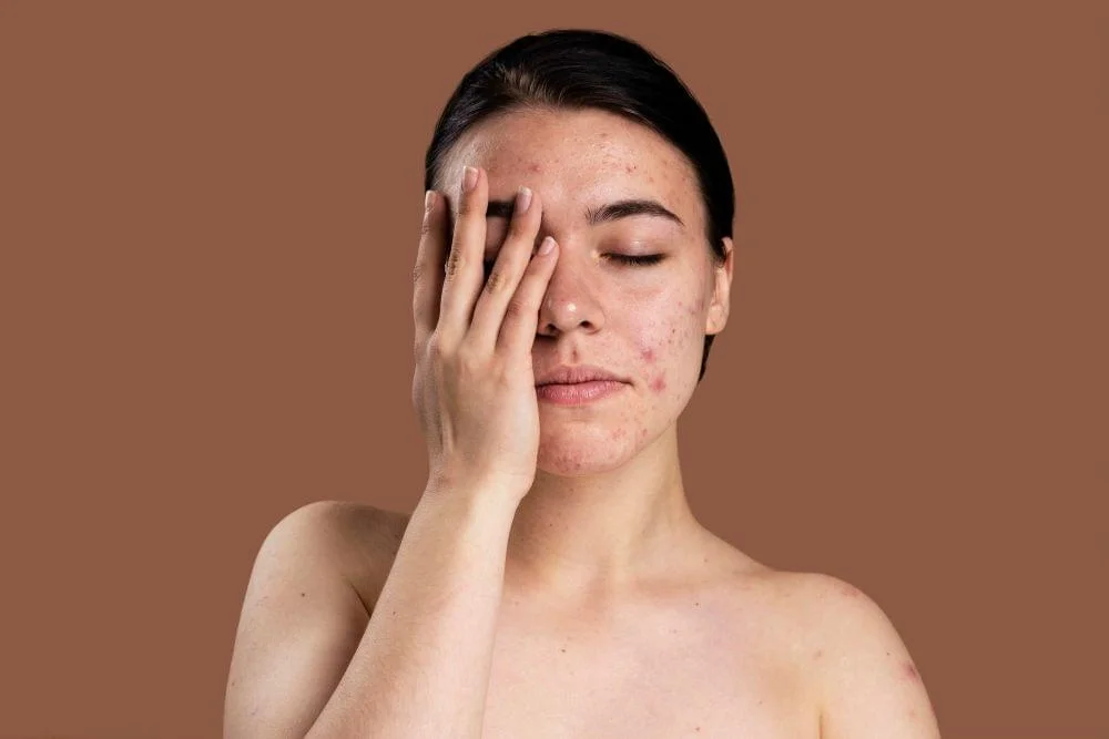 Acne Treatment in Mumbai | Acne Doctor in Mumbai | Acne Treatment in Chembur