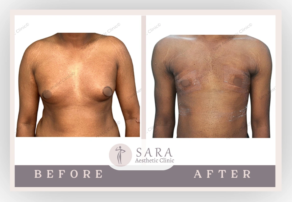 Best Gynecomastia Surgery | Dr. Ankita Jawanjal, Mumbai